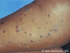 Image result for Eczema On Darker Skin