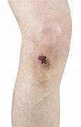 Image result for Knee Scab