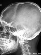 Image result for Skull Fracture