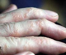 Image result for Eczema Rash On Hands