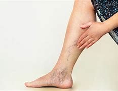 Image result for Nonphasic Venous Flow