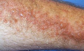 Image result for Poison Ivy Rash African American