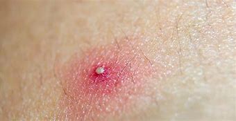 Image result for Pustules Skin Disease