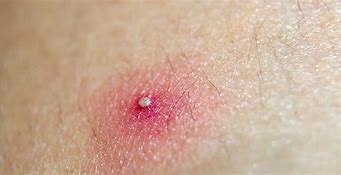 Image result for Pustules Back