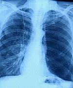 Image result for Bullous Emphysema X-ray