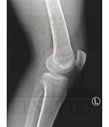 Image result for Normal Lateral Knee Radiograph