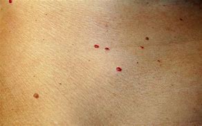 Image result for Dark Red Spots On Skin