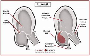 Image result for Mild Mr Heart