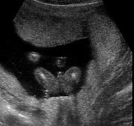 Image result for Ultrasound of Baby Boy