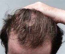 Image result for Low Dose Minoxidil for Hair Loss