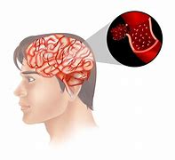 Image result for Brain Cancer Photo Human