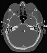 Image result for Sphenopalatine Foramen Radiology