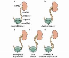 Image result for J-shaped Ureter