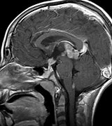 Image result for Teratoma Brain Tumor