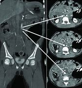 Image result for CT Angiogram Abdomen