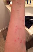 Image result for Bed Bug Bites Row