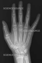 Image result for Normal Hand Radiograph