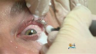 Image result for Mites in Eyes