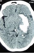 Image result for CT Brain Lentiform Nucleus