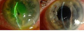 Image result for Corneal Perforation