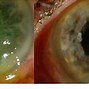 Image result for Corneal Perforation