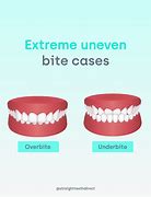 Image result for Ideal Bite Teeth