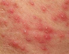 Image result for Pustular Skin