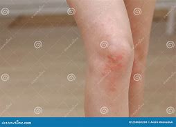 Image result for Allergic Reaction with Pustules