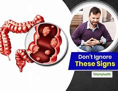 Image result for Colon Cancer Symptoms in Men Signs