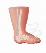 Image result for Heel Cord Tenotomy