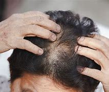 Image result for Low Dose Minoxidil for Hair Loss