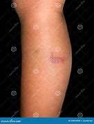 Image result for Lower Leg Pustules