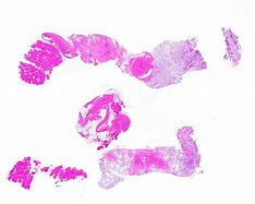 Image result for Myxoid Liposarcoma