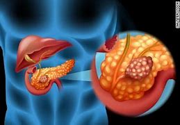 Image result for Pancreatic Adenocarcinoma