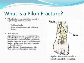 Image result for Open Pilon Fracture