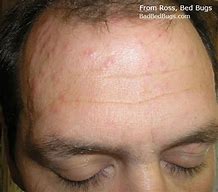 Image result for Bed Bug Bites Groin