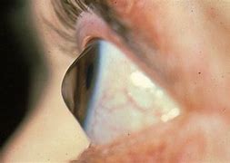 Image result for Corneal Defect