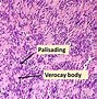 Image result for Vestibular Schwannoma Gross Pathology