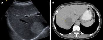 Image result for Hemangioma Ultrasound