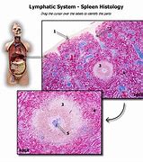 Image result for Spleen Metastasis