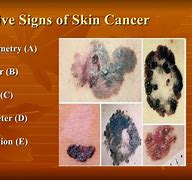 Image result for 5 Warning Signs of Skin Cancer