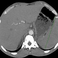 Image result for Spleen Enlargement CT