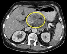 Image result for Pancreatic Adenocarcinoma