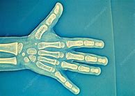 Image result for Child's Hand X-ray