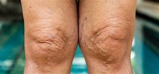 Image result for Thickened Skin On Lower Legs