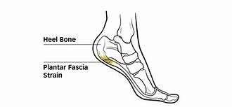 Image result for Mechanics of Plantar Fascia