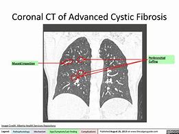 Image result for Coronal Lung CT