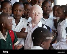 Image result for Albino Boy