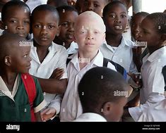 Image result for South African Albino