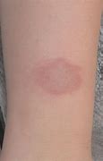 Image result for Small Red Circular Rash On Skin